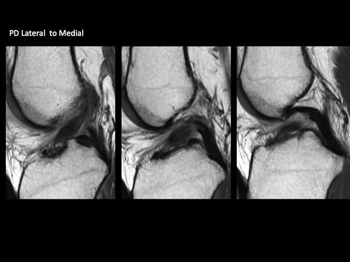 Figure 3 for case anterior cruciate ligament ( RID2781 )